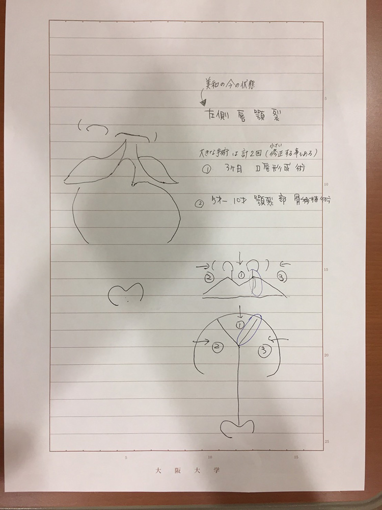 口唇口蓋裂の説明図