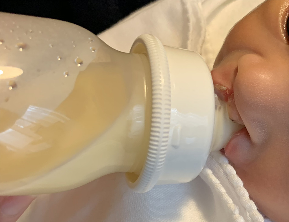 口唇口蓋裂の授乳