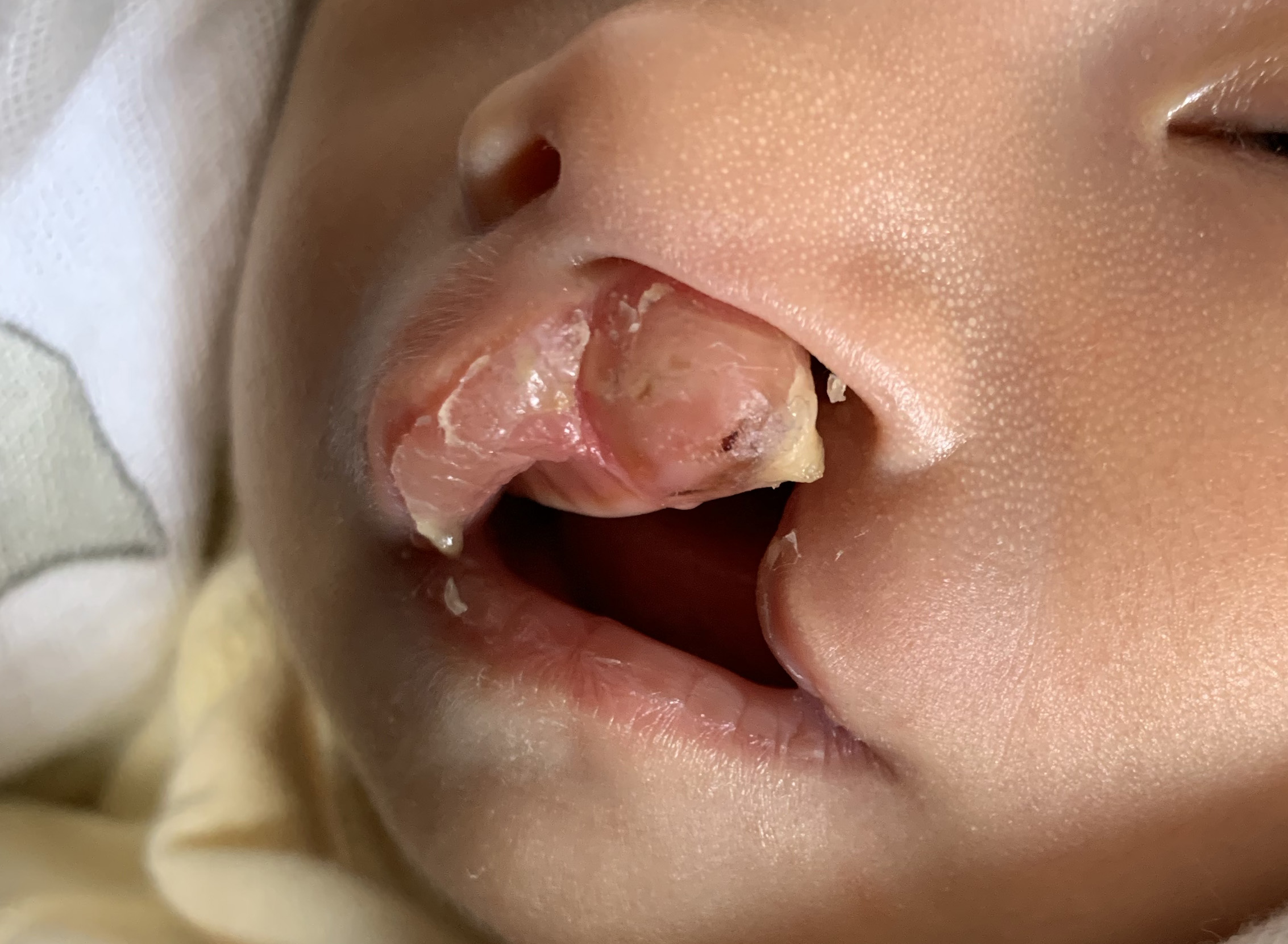 口唇口蓋裂　白っぽい